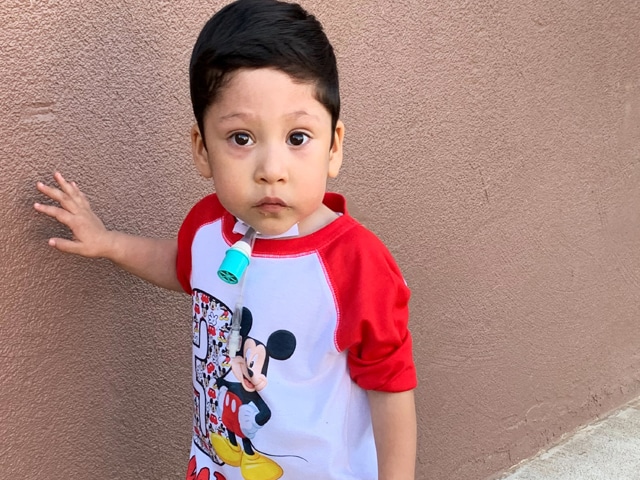 Mathias had a procedure to insert a breathing tube into his trachea, which allowed him to eventually leave the hospital and use a home ventilator.