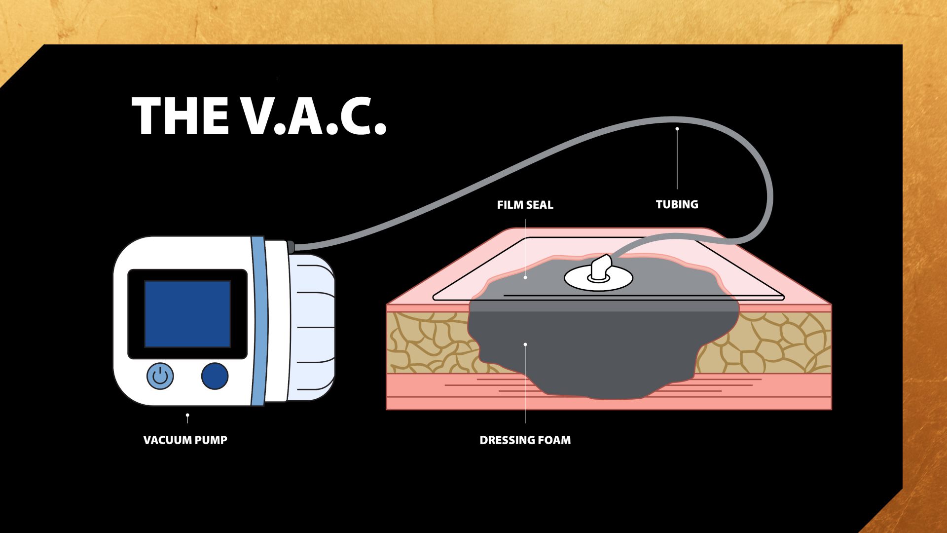 Diagram of a vacuum-assisted closure (V.A.C.) system showing a vacuum pump connected by tubing to dressing foam over a wound, sealed with a film.
