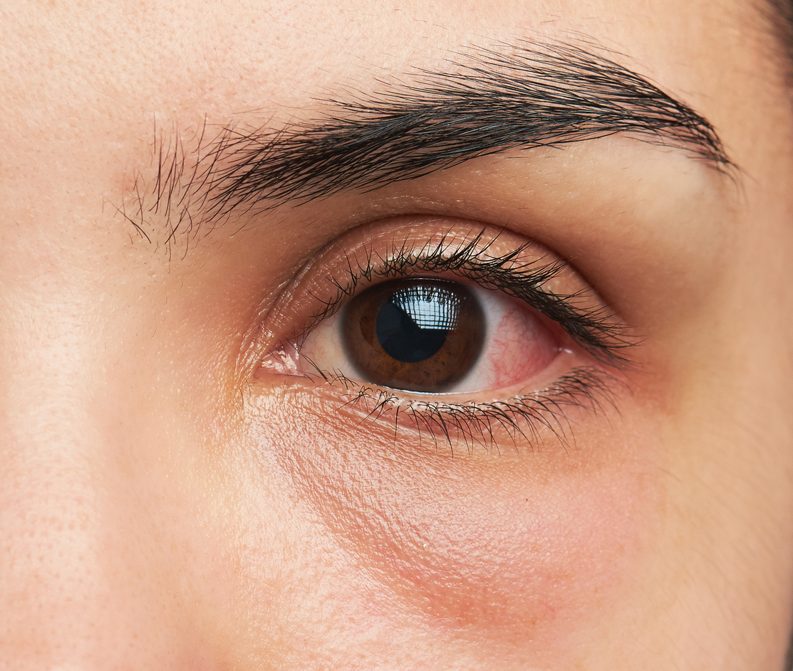 Close-up of a human eye with brown iris, visible eyelashes, eyebrow, and some redness in the white of the eye.